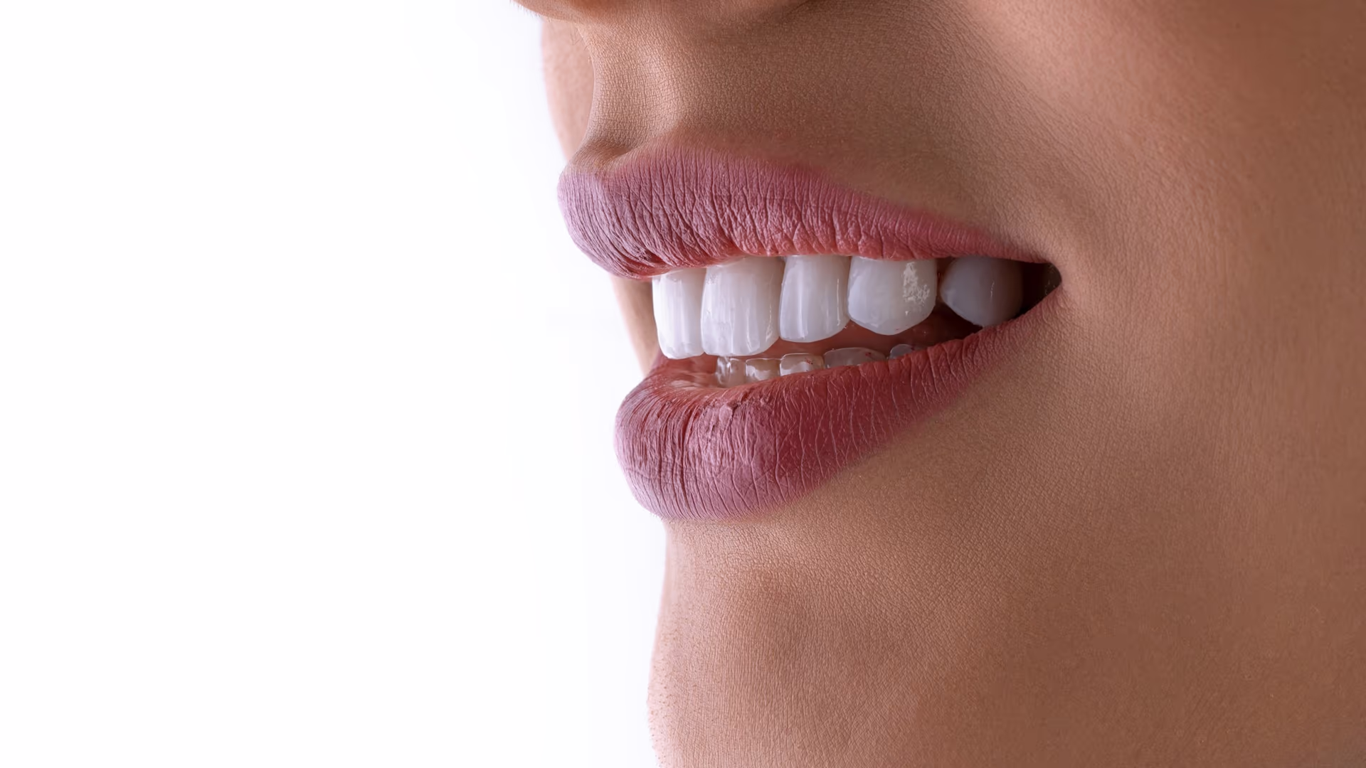 Professionelle Zahnaufhellung bei Dreamify Smile in Köln, Berlin und München